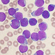 This bone marrow aspirate smear of precursor B-cell acute lymphoblastic leukemia fully supports overturning the new legislation.